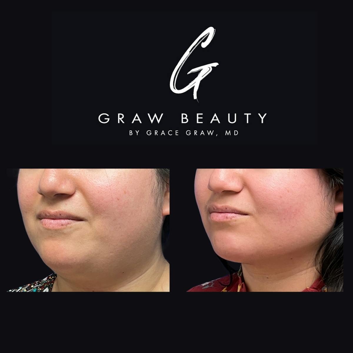Face and Neck Before & After Gallery - Patient 147739683 - Image 2