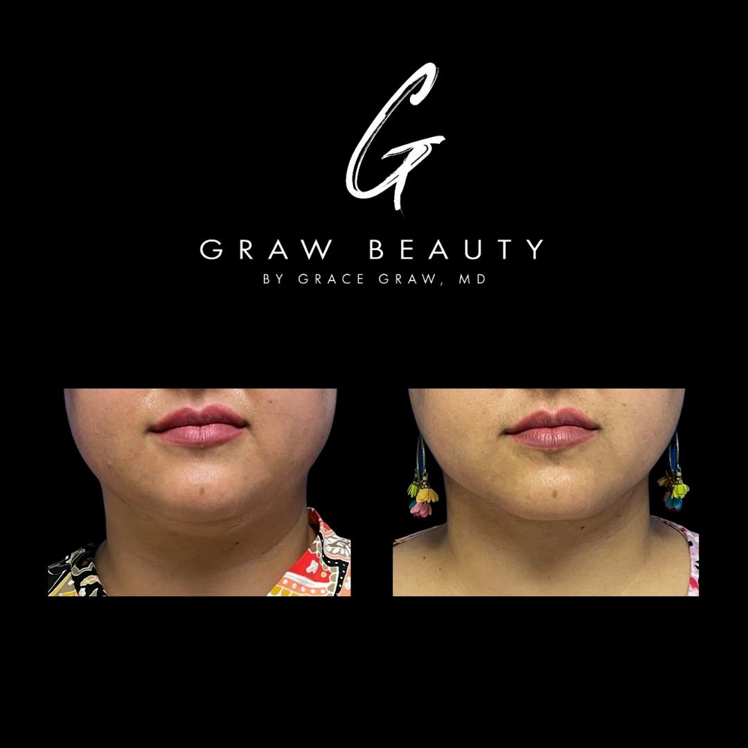 Face and Neck Before & After Gallery - Patient 147739686 - Image 1
