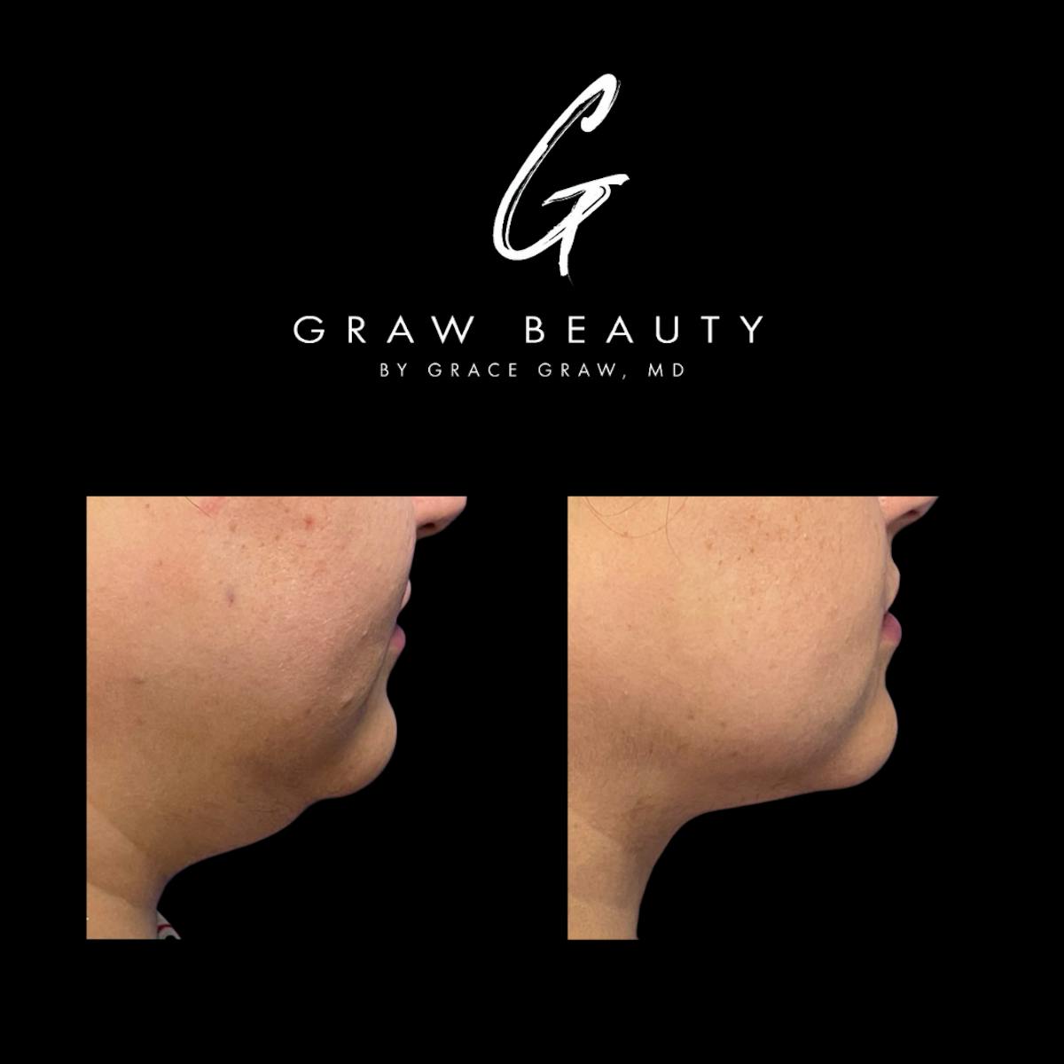 Face and Neck Before & After Gallery - Patient 147739686 - Image 3