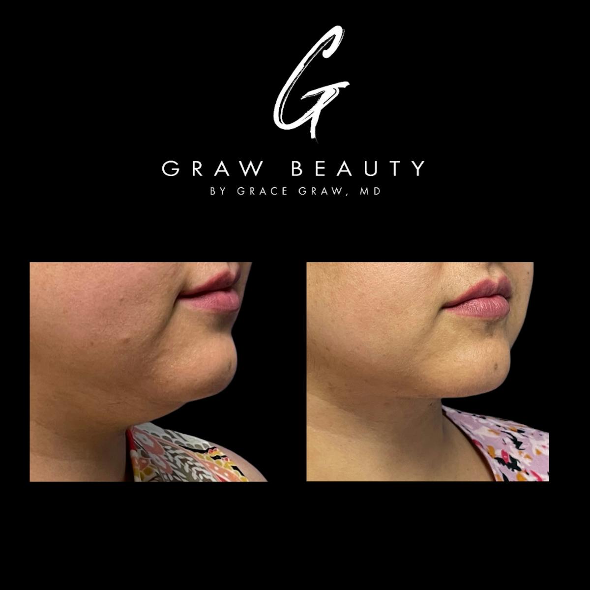 Face and Neck Before & After Gallery - Patient 147739686 - Image 2