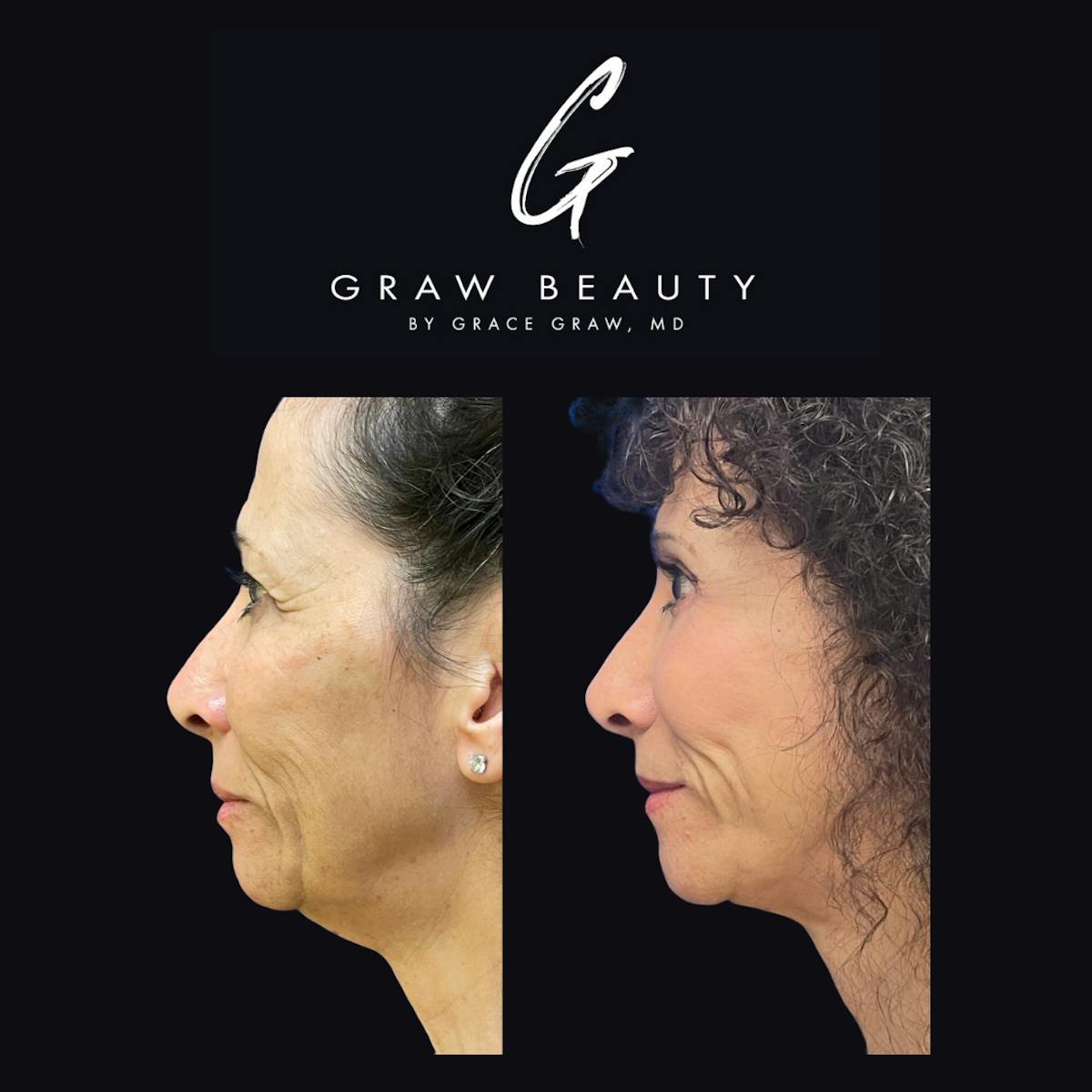 Eyelids Before & After Gallery - Patient 147739707 - Image 3