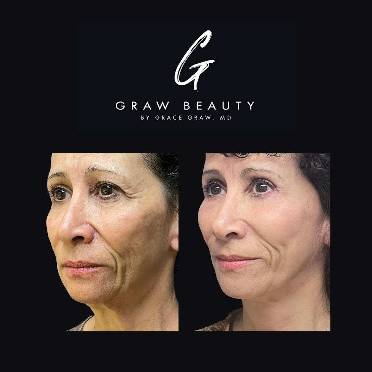 Eyelids Before & After Gallery - Patient 147739707 - Image 2