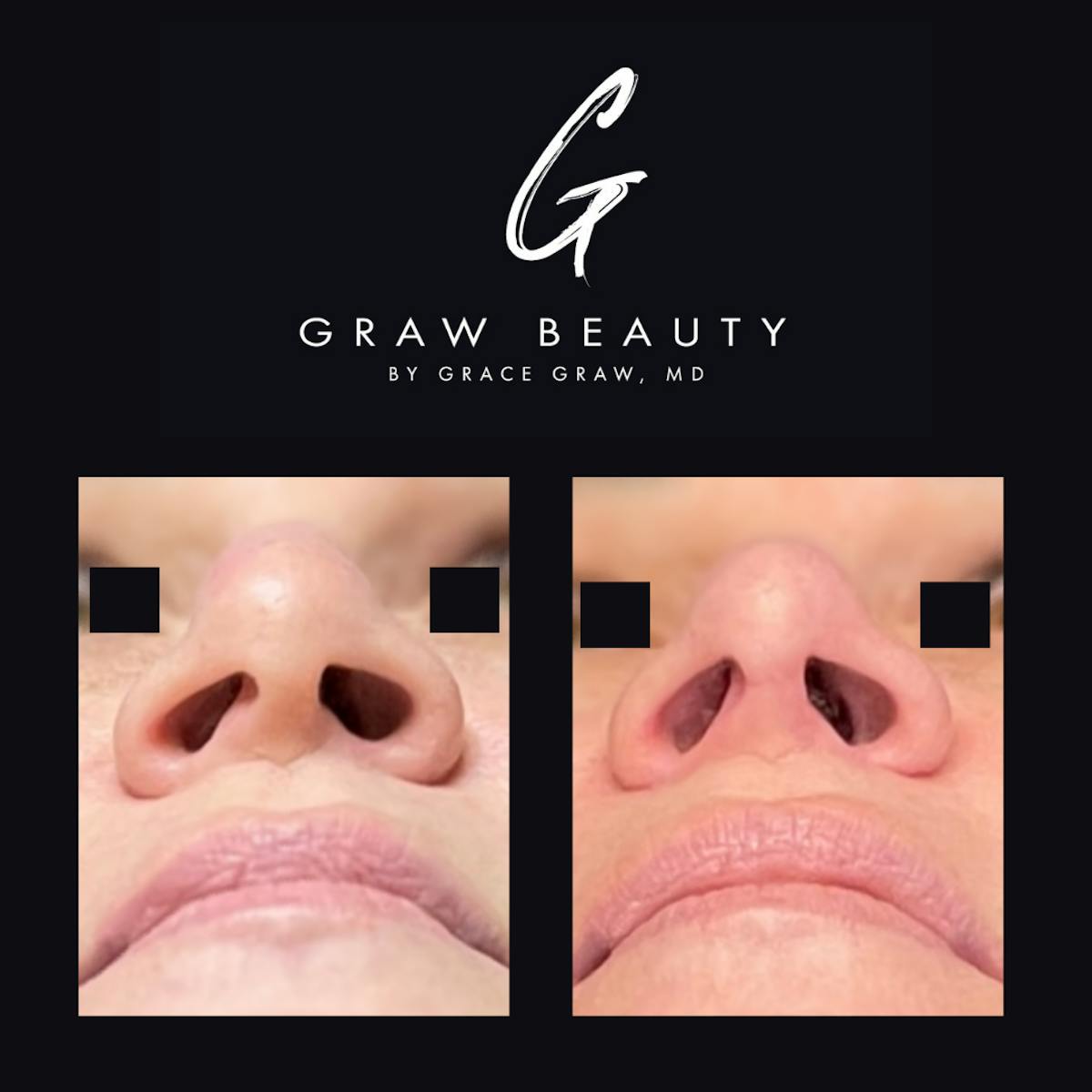Nose Before & After Gallery - Patient 147739716 - Image 2