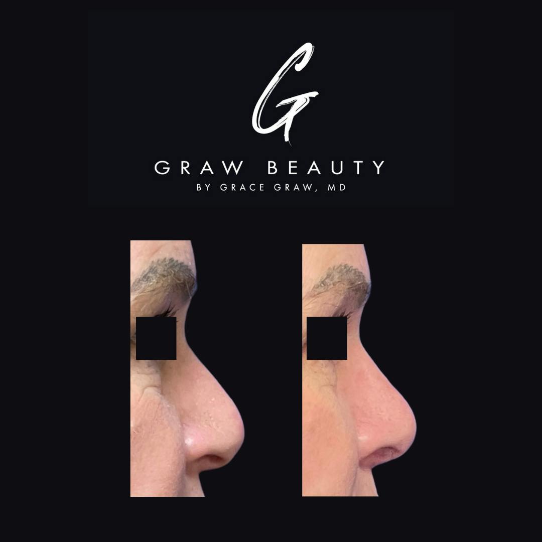 Nose Before & After Gallery - Patient 147739716 - Image 3