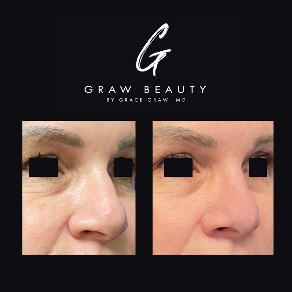 Nose Before & After Gallery - Patient 147739716 - Image 4