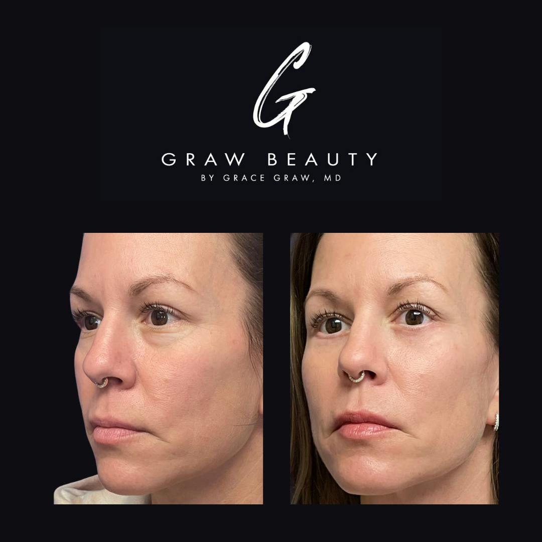 Eyelids Before & After Gallery - Patient 154505585 - Image 2