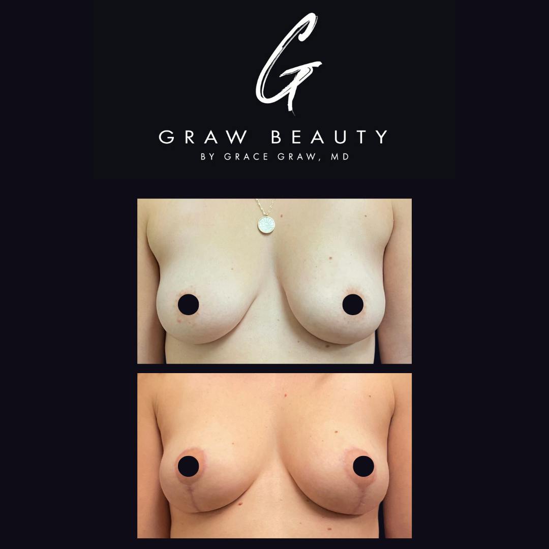 Breast Lift Before & After Gallery - Patient 154505609 - Image 1
