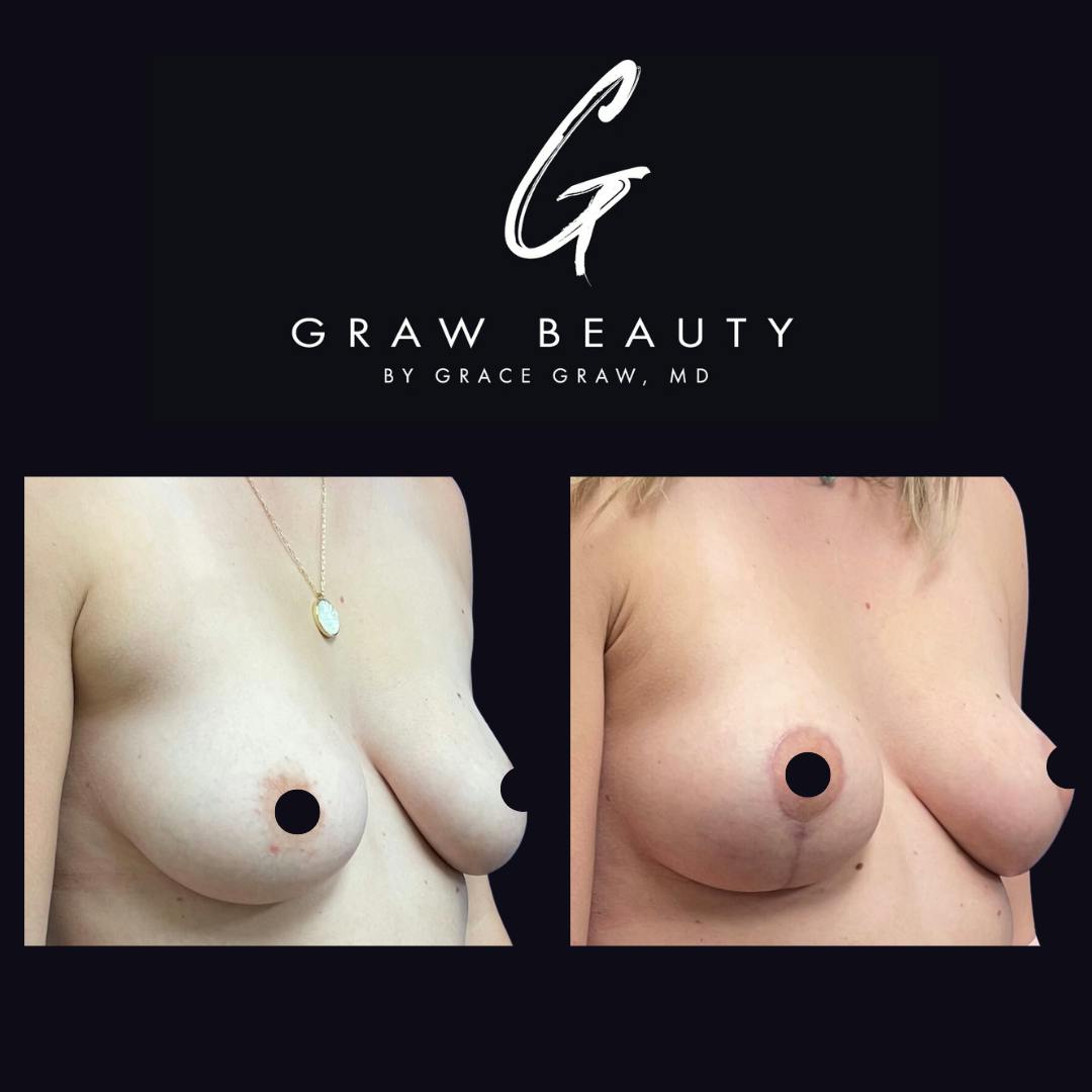 Breast Lift Before & After Gallery - Patient 154505609 - Image 2