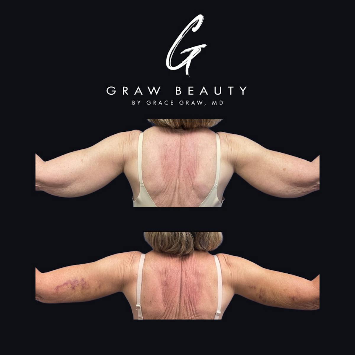 Arms Before & After Gallery - Patient 403111 - Image 2