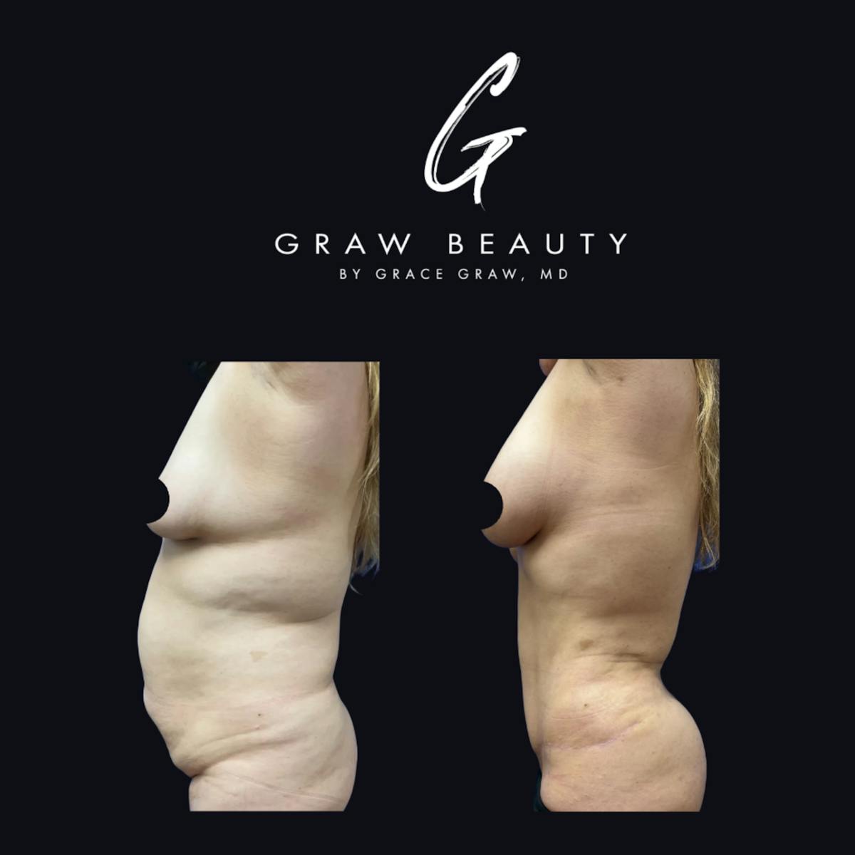 Liposuction Before & After Gallery - Patient 911983 - Image 2