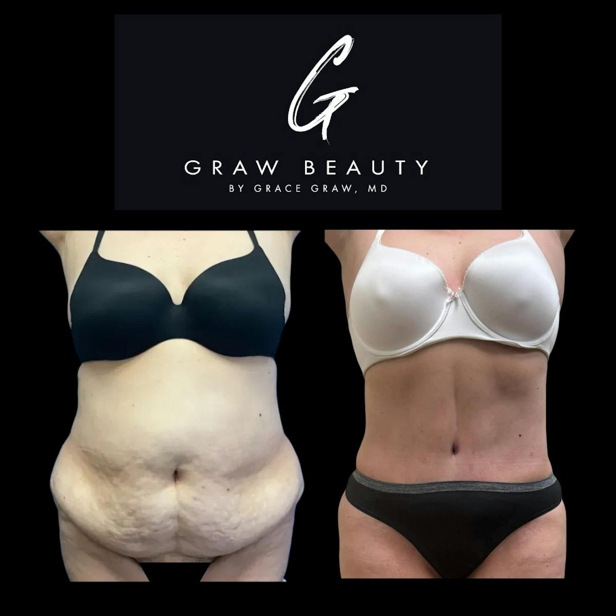 Abdominoplasty Before & After Gallery - Patient 303347 - Image 3