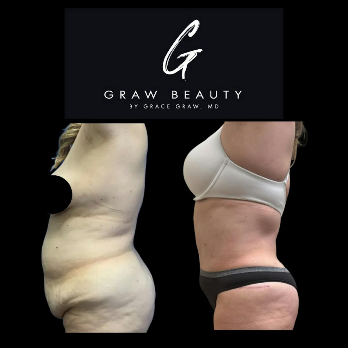 Abdominoplasty Before & After Gallery - Patient 303347 - Image 2
