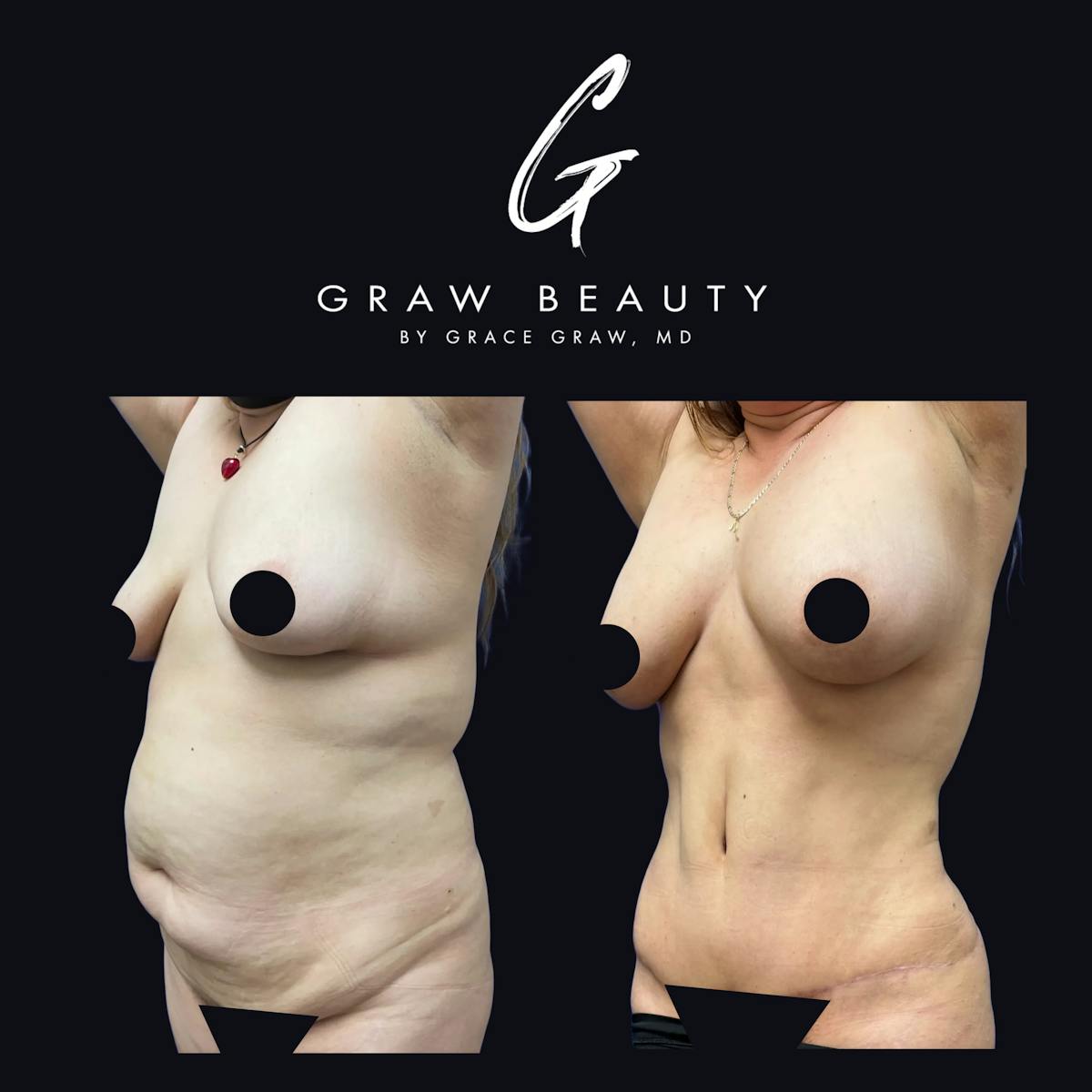 Abdominoplasty Before & After Gallery - Patient 663785 - Image 1