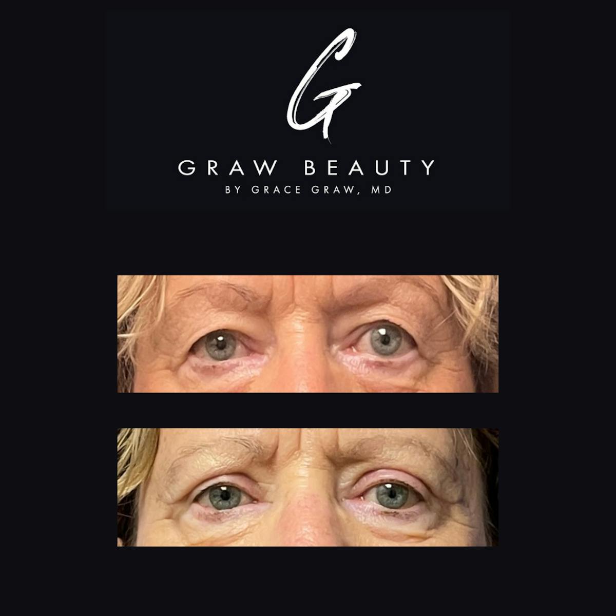 Eyelids Before & After Gallery - Patient 546144 - Image 2