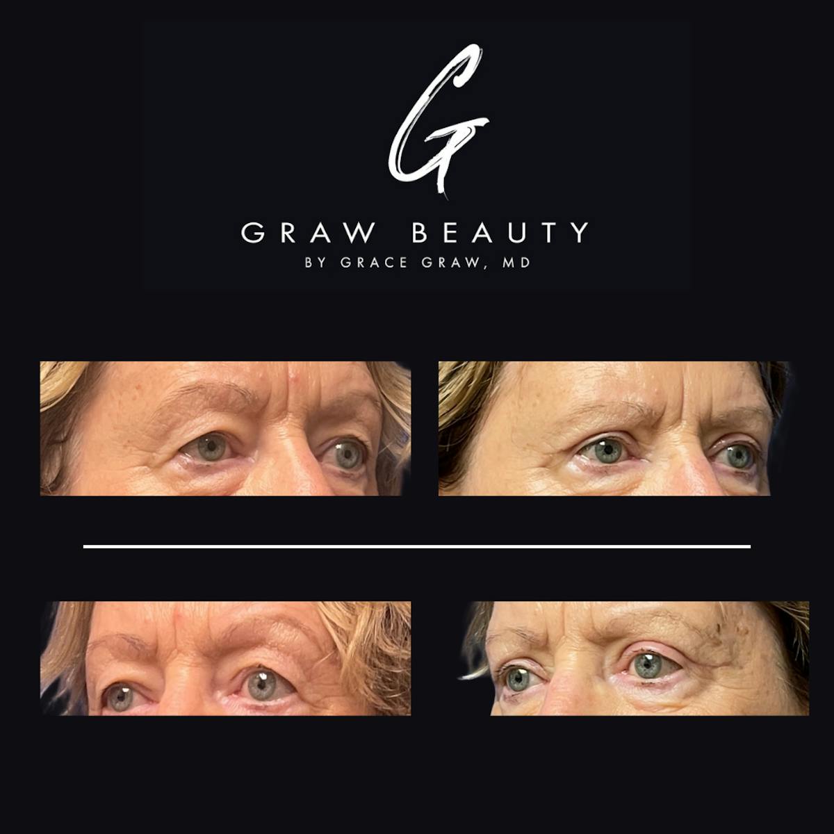 Eyelids Before & After Gallery - Patient 546144 - Image 4