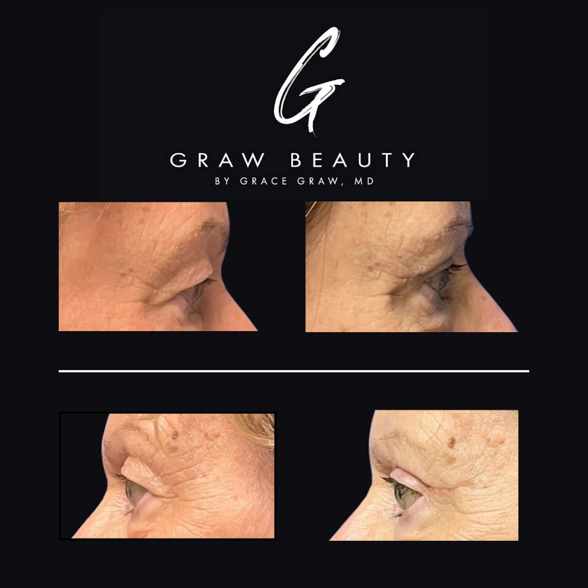 Eyelids Before & After Gallery - Patient 546144 - Image 3