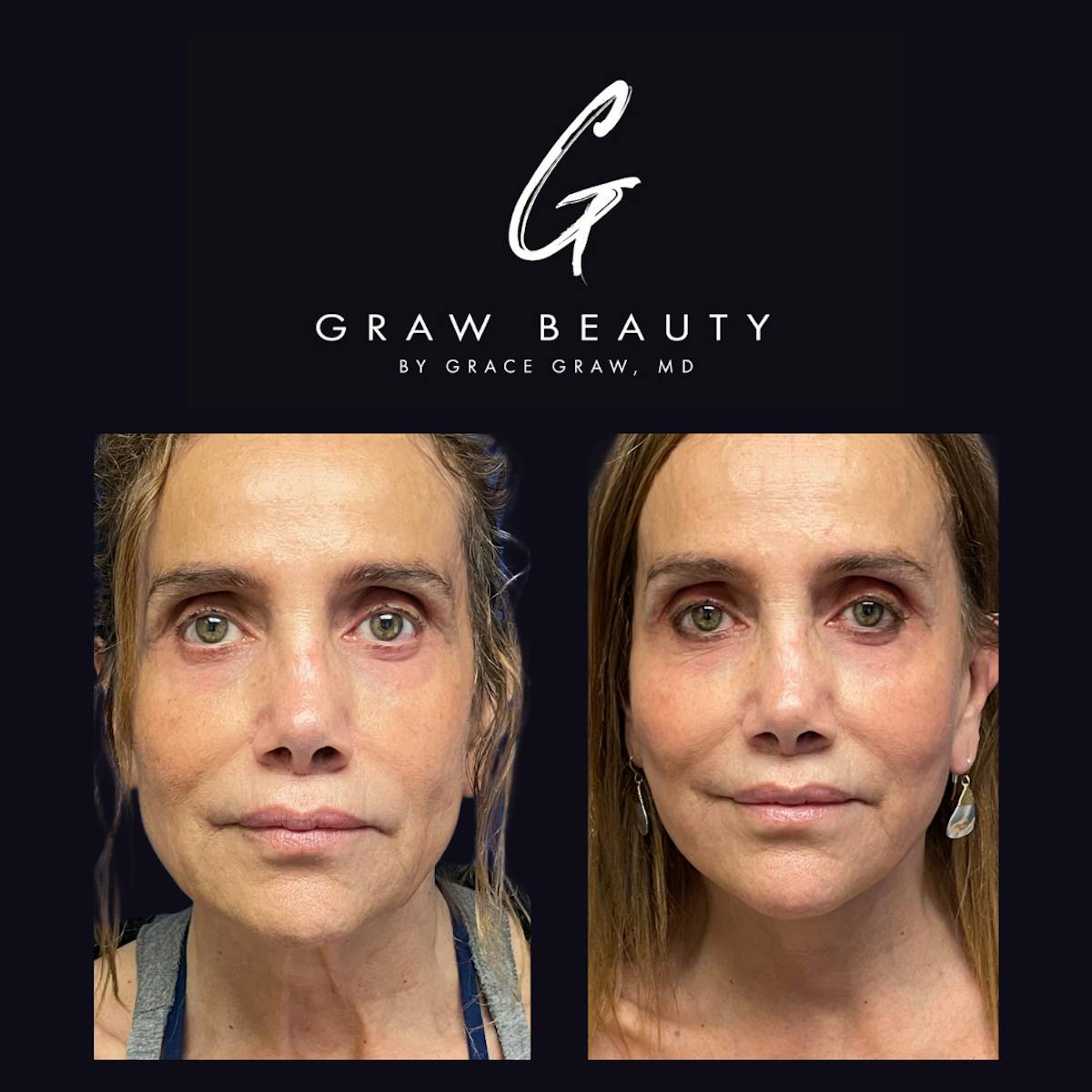 Face and Neck Before & After Gallery - Patient 316825 - Image 1