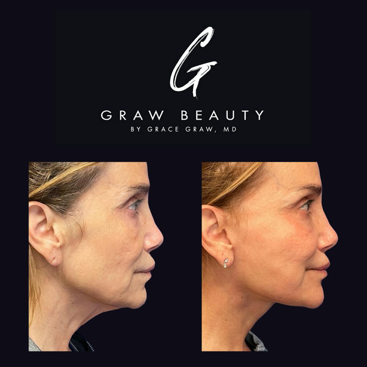 Face and Neck Before & After Gallery - Patient 316825 - Image 2