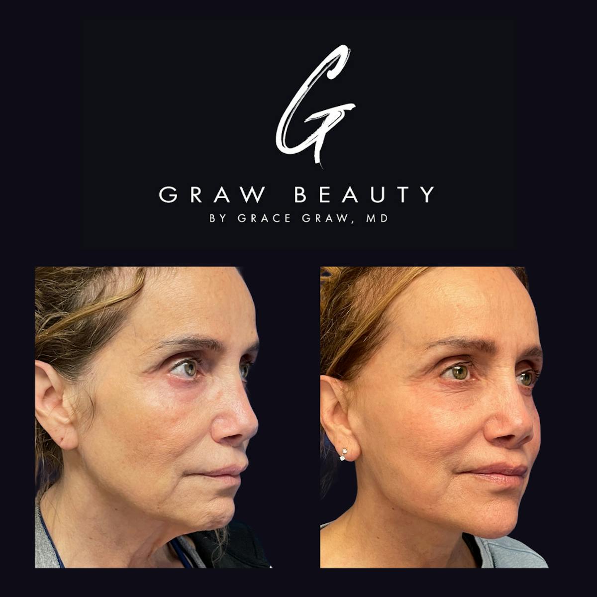 Face and Neck Before & After Gallery - Patient 316825 - Image 3