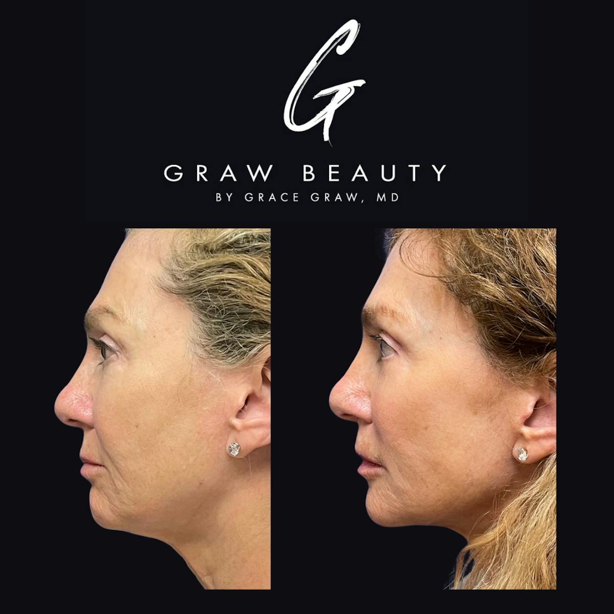 Face and Neck Before & After Gallery - Patient 400875 - Image 2