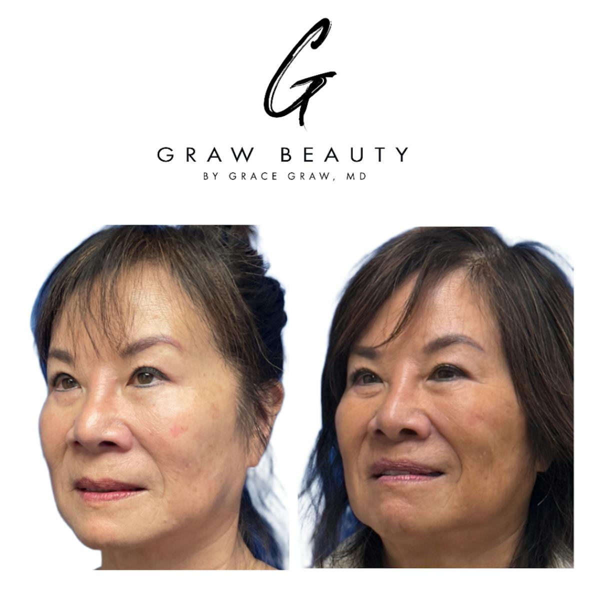 Lip Lift  Before & After Gallery - Patient 238330 - Image 3
