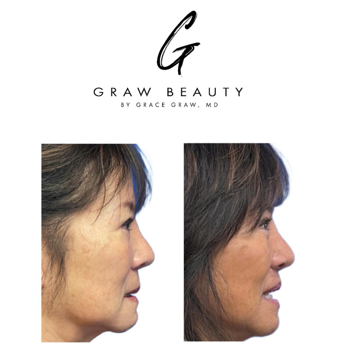 Lip Lift  Before & After Gallery - Patient 238330 - Image 4