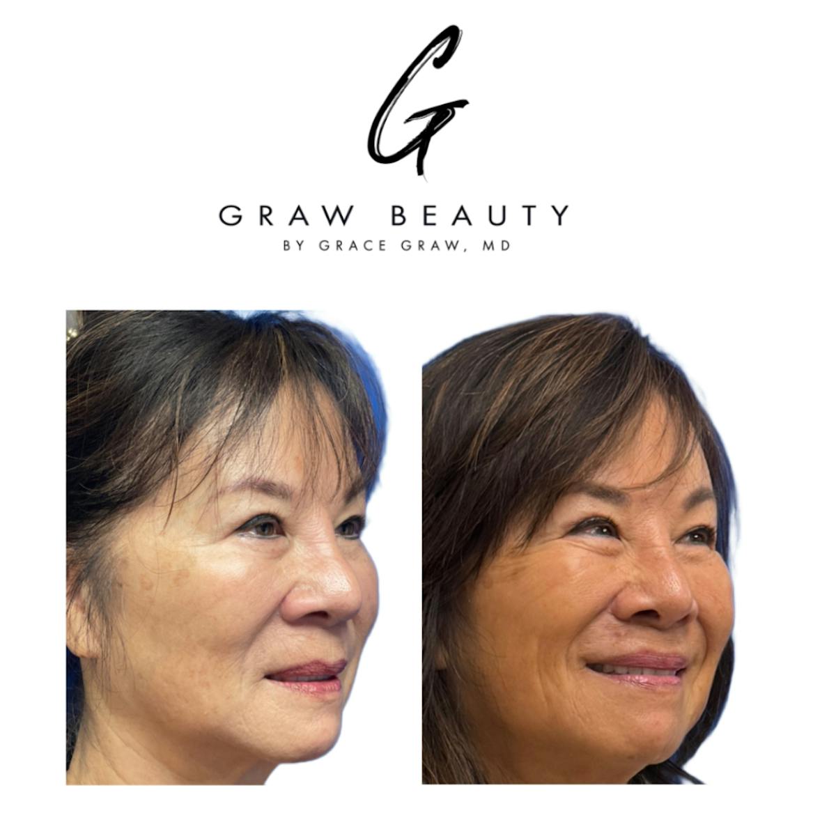 Lip Lift  Before & After Gallery - Patient 238330 - Image 5