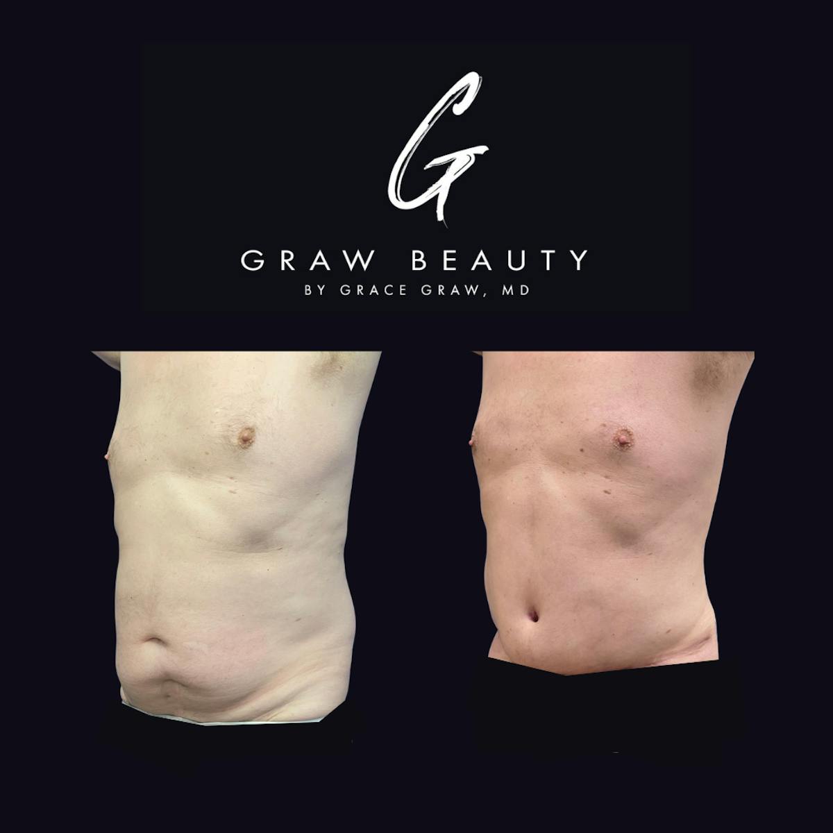 Abdominoplasty Before & After Gallery - Patient 156387 - Image 2