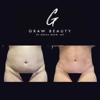 Abdominoplasty Before & After Gallery - Patient 123193 - Image 1