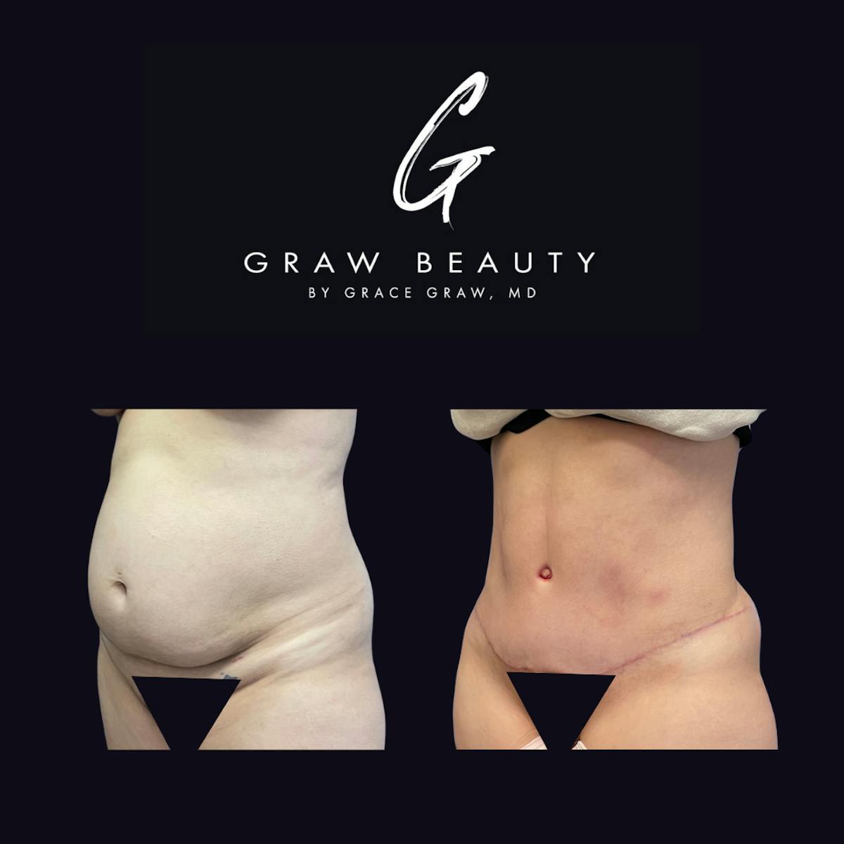 Abdominoplasty Before & After Gallery - Patient 123193 - Image 2