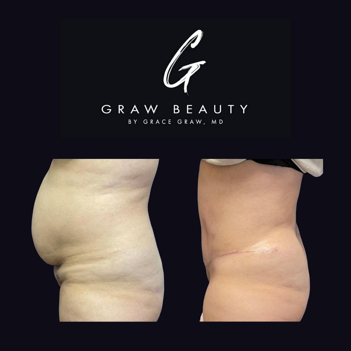 Abdominoplasty Before & After Gallery - Patient 123193 - Image 3