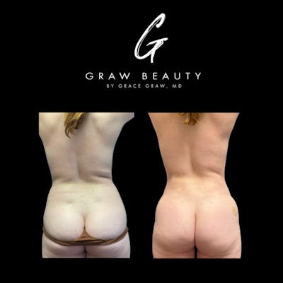 Liposuction + Fat Grafting Before & After Gallery - Patient 187095 - Image 1