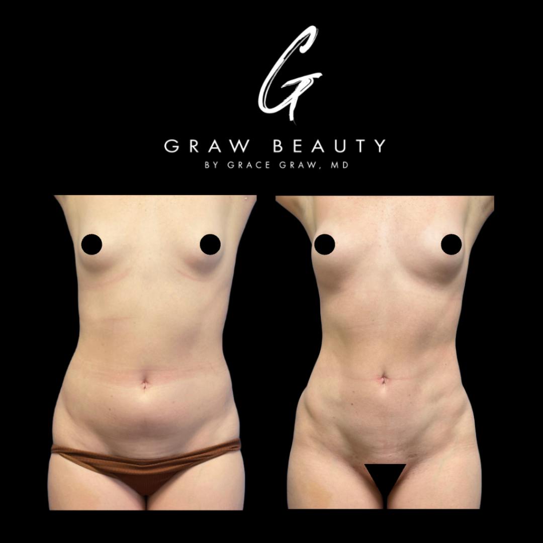 before image of liposuction with fat grafting patient