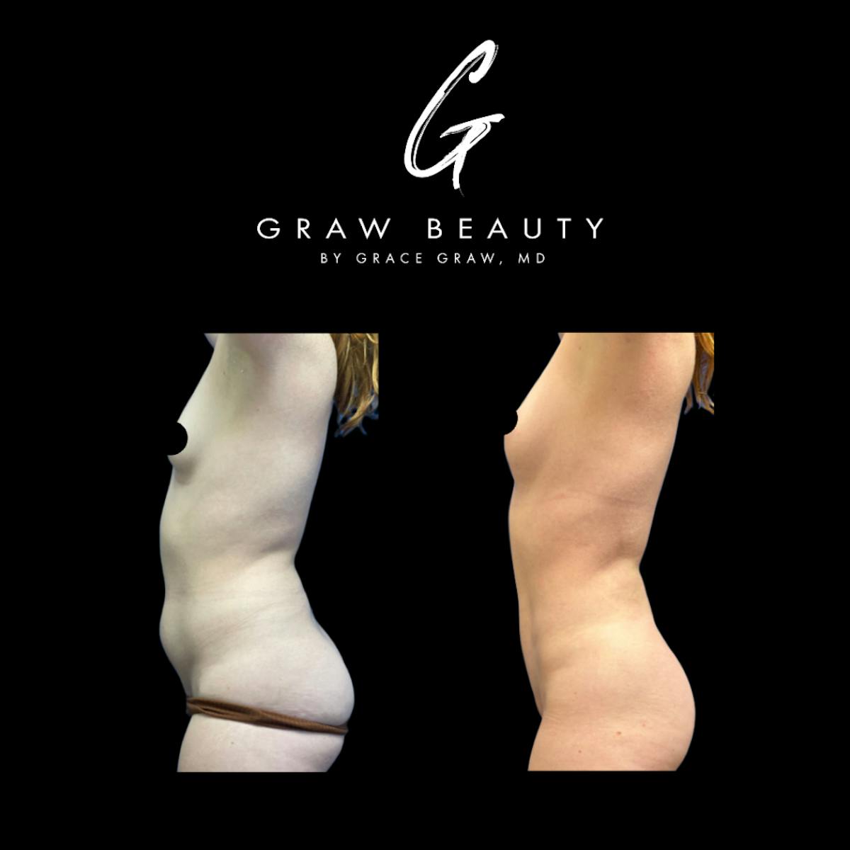 Liposuction + Fat Grafting Before & After Gallery - Patient 187095 - Image 3
