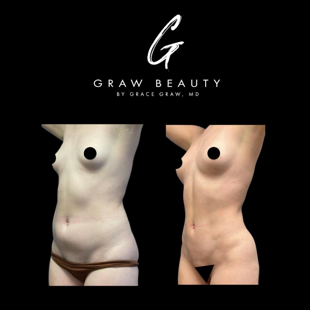 Liposuction + Fat Grafting Before & After Gallery - Patient 187095 - Image 4