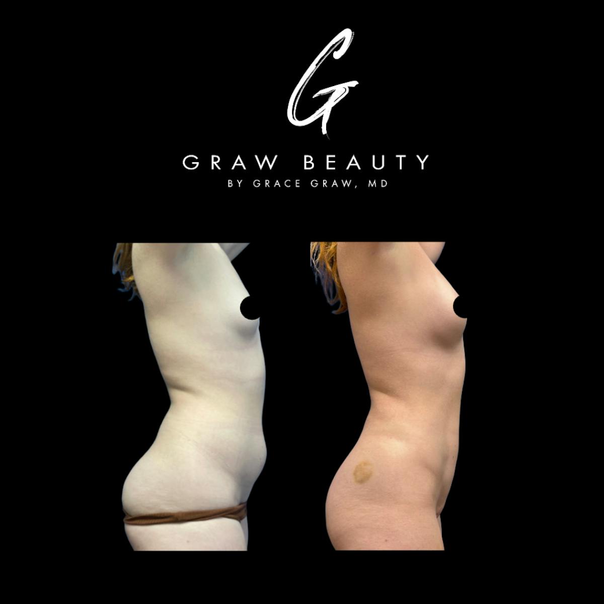 Liposuction + Fat Grafting Before & After Gallery - Patient 187095 - Image 5