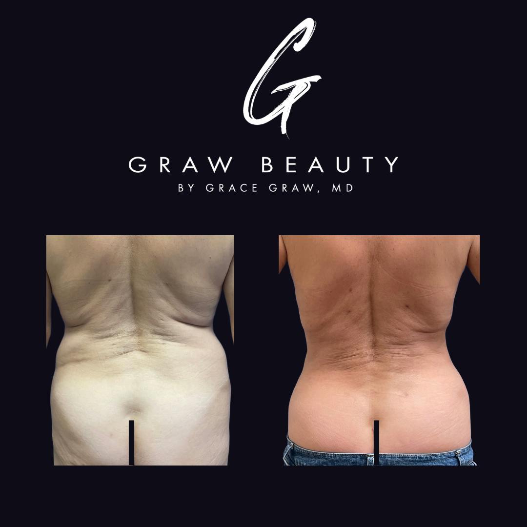 before image of liposuction patient