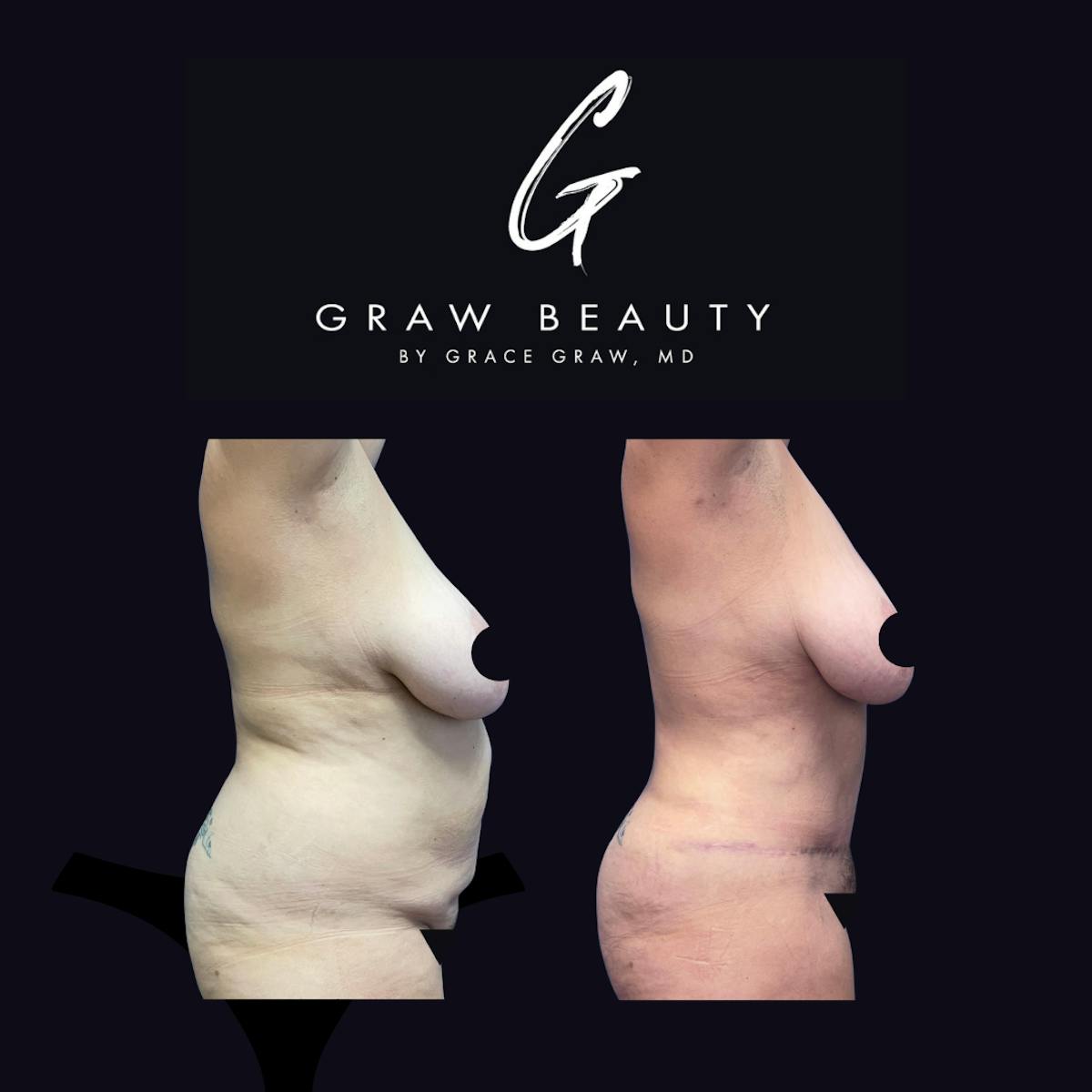 Abdominoplasty Before & After Gallery - Patient 298935 - Image 3