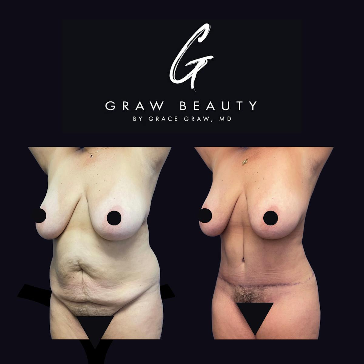 Abdominoplasty Before & After Gallery - Patient 298935 - Image 4