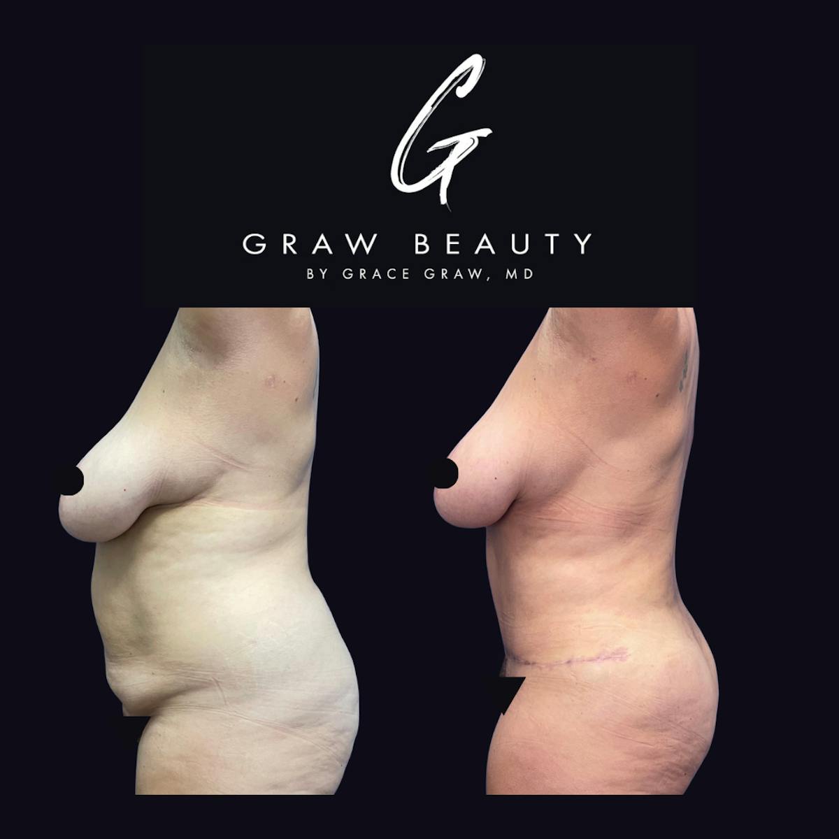 Abdominoplasty Before & After Gallery - Patient 298935 - Image 5