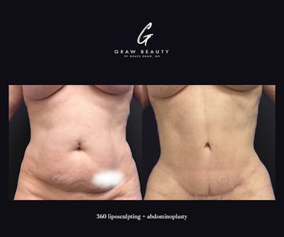 Abdominoplasty Before & After Gallery - Patient 188662 - Image 1