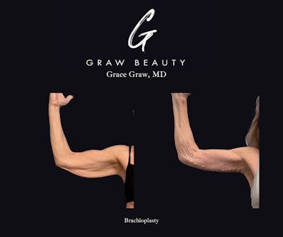 Arms Before & After Gallery - Patient 123767 - Image 1