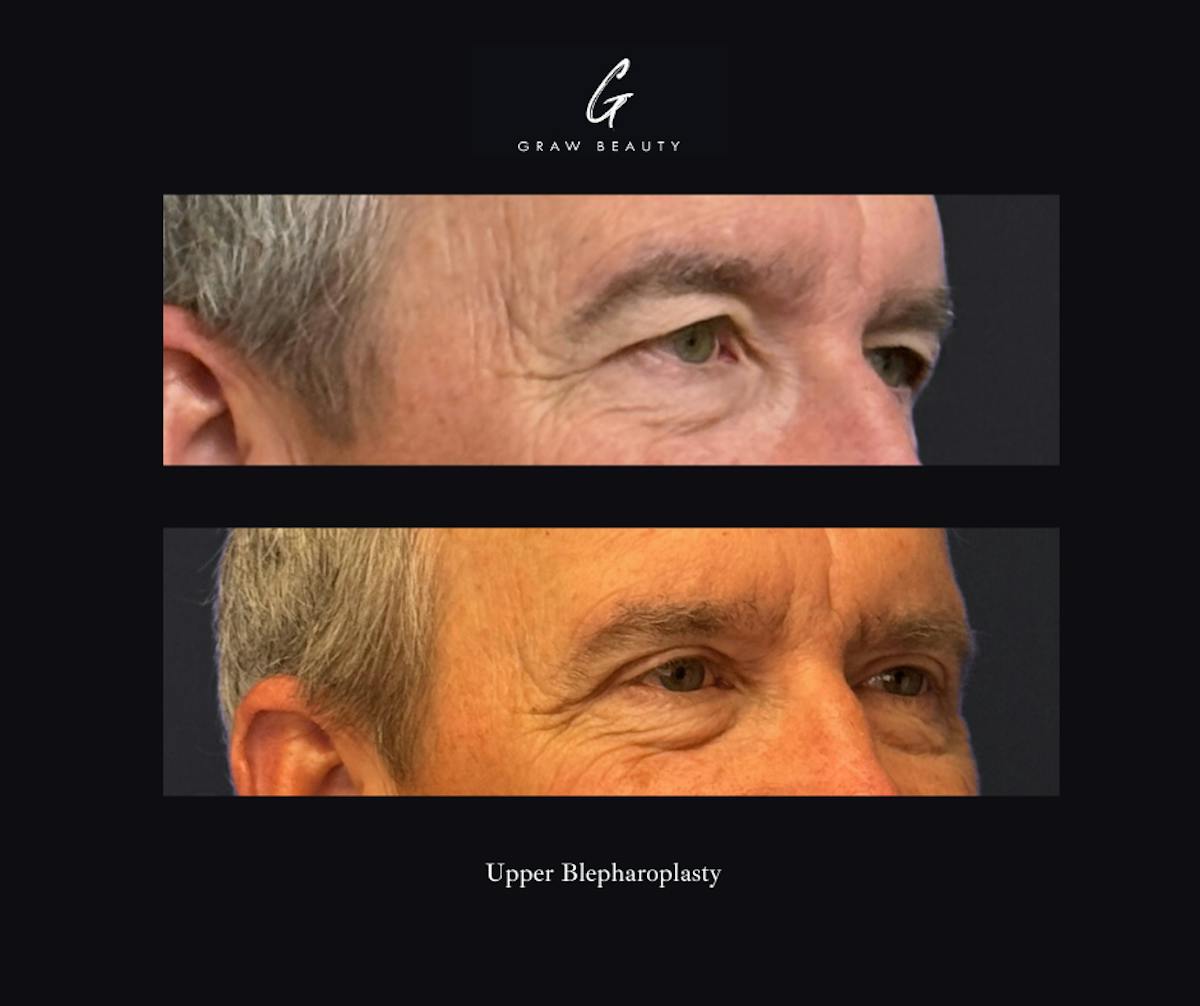 Eyelids Before & After Gallery - Patient 301673 - Image 2
