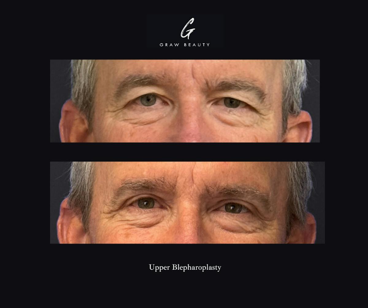 Eyelids Before & After Gallery - Patient 301673 - Image 1