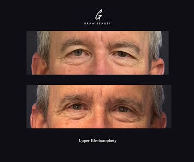 Eyelids Before & After Gallery - Patient 301673 - Image 1