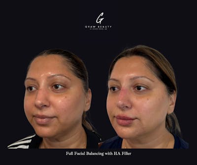 Face and Neck Before & After Gallery - Patient 360979 - Image 1