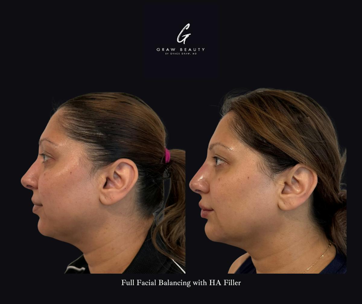 Face and Neck Before & After Gallery - Patient 360979 - Image 2