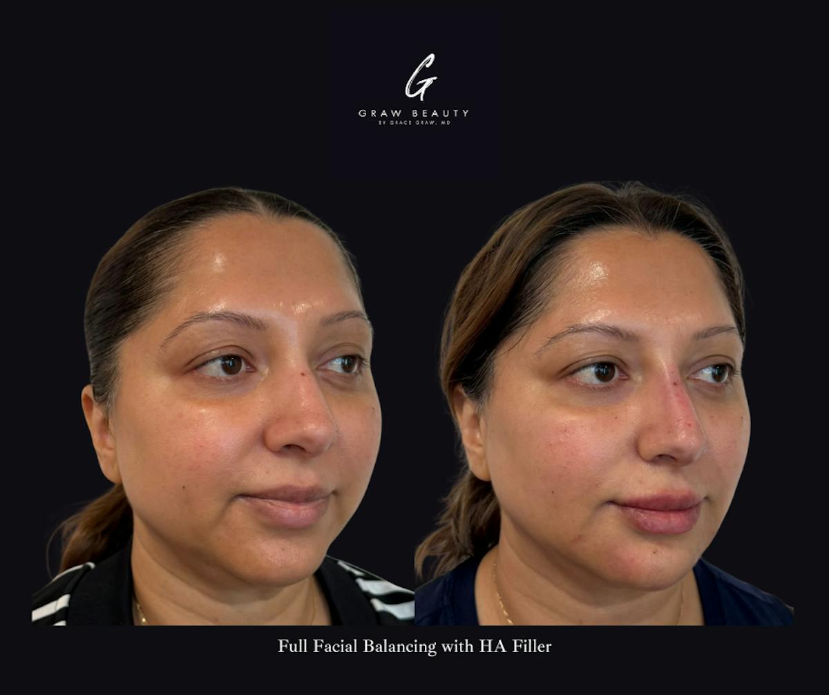 Face and Neck Before & After Gallery - Patient 360979 - Image 3