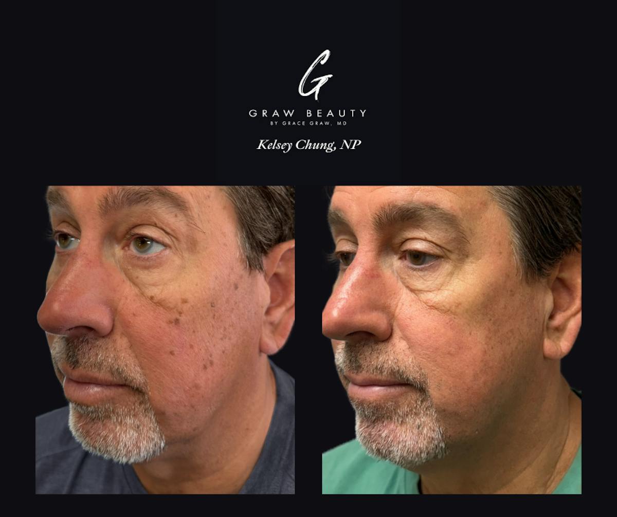 Face and Neck Before & After Gallery - Patient 391212 - Image 1