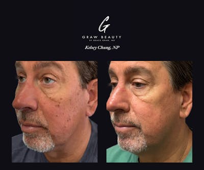 Face and Neck Before & After Gallery - Patient 391212 - Image 1